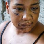 Las heridas de Nayely: sobreviviente de un ataque en La Vega