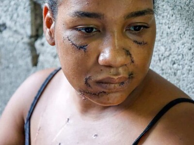 Las heridas de Nayely: sobreviviente de un ataque en La Vega