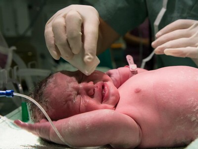 Parto vaginal versus cesárea: beneficios y riesgos de cada opción de nacimiento