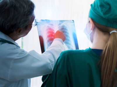 Diagnóstico precoz del cáncer pulmonar: tumor del papa León XIV fue extirpado
