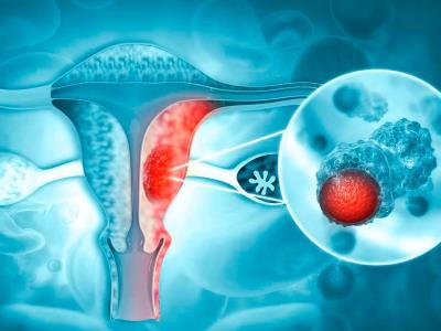 El cáncer es la principal causa de muerte entre hispanos en EE. UU